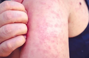 Hives vs Eczema 